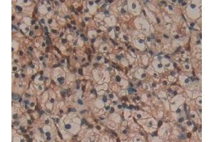 Detection of GAL1 in Human Renal cancer Tissue using Polyclonal Antibody to Galectin 1 (GAL1)