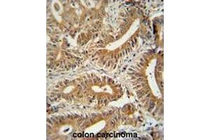 CCDC123 antibody (C-term) immunohistochemistry analysis in formalin fixed and paraffin embedded human colon carcinoma followed by peroxidase conjugation of the secondary antibody and DAB staining. (CEP89 anticorps  (C-Term))