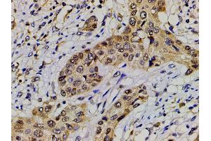 ABIN6277691 at 1/200 staining human esophageal carcinoma tissue sections by IHC-P. (Ephrin B2 anticorps  (C-Term))