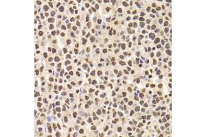 Immunohistochemistry of paraffin-embedded human B cell lymphoma using ANP32A Antibody.