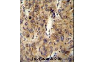 ACF Antibody (C-term) (ABIN654627 and ABIN2844324) immunohistochemistry analysis in formalin fixed and paraffin embedded human hepatocarcinoma followed by peroxidase conjugation of the secondary antibody and DAB staining. (A1CF anticorps  (C-Term))