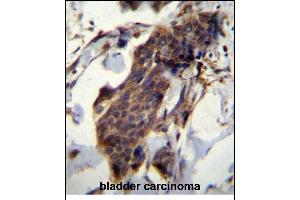 CCDC13 Antibody (N-term) (ABIN656615 and ABIN2845868) immunohistochemistry analysis in formalin fixed and paraffin embedded human bladder carcinoma followed by peroxidase conjugation of the secondary antibody and DAB staining. (CCDC13 anticorps  (N-Term))