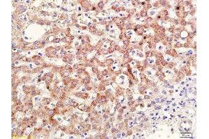 Formalin-fixed and paraffin embedded human cervical carcinoma labeled with Anti-RAR Beta Polyclonal Antibody , Unconjugated at 1:400, followed by conjugation to the secondary antibody and DAB staining