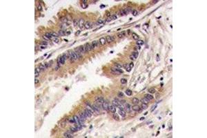 IHC analysis of FFPE human lung carcinoma tissue stained with ERK4 antibody