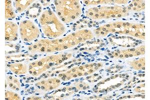ABIN6263049 and ABIN6273132 at 1/100 staining Human kidney cancer and adjacent normal tissues by IHC-P. (MAD2L2 anticorps  (Internal Region))