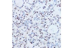 Immunohistochemistry of paraffin-embedded human thyroid cancer using SSB Rabbit pAb (ABIN3015264, ABIN3015265, ABIN3015266 and ABIN6213909) at dilution of 1:300 (40x lens).
