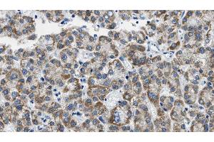 ABIN6268888 at 1/100 staining Human liver cancer tissue by IHC-P. (CD4 anticorps  (C-Term))
