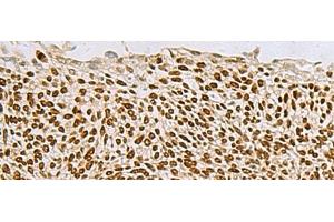 Immunohistochemistry of paraffin-embedded Human lung cancer tissue using TP63 Polyclonal Antibody at dilution of 1:65(x200) (p63 anticorps)