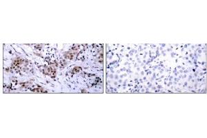 Immunohistochemical analysis of paraffin-embedded human breast carcinoma tissue using Estrogen Receptor-α (Ab-167) antibody (E021068). (Estrogen Receptor alpha anticorps)