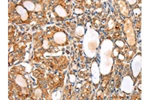 The image on the left is immunohistochemistry of paraffin-embedded Human thyroid cancer tissue using ABIN7192531(SLC8B1 Antibody) at dilution 1/20, on the right is treated with synthetic peptide. (SLC24A6 anticorps)