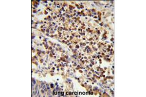 Formalin-fixed and paraffin-embedded human lung carcinoma reacted with , which was peroxidase-conjugated to the secondary antibody, followed by DAB staining.