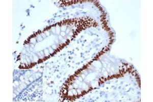 IHC analysis of formalin-fixed, paraffin-embedded human colon adenocarcinoma.