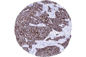 Squamous cell carcinoma of the penis with intense membranous Dsg3 immunostaining of tumor cells