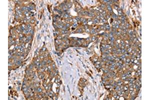 The image on the left is immunohistochemistry of paraffin-embedded Human cervical cancer tissue using ABIN7129551(FUCA1 Antibody) at dilution 1/30, on the right is treated with fusion protein. (FUCA1 anticorps)
