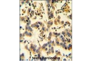 Antibody (C-term) (ABIN654184 and ABIN2844036) immunohistochemistry analysis in formalin fixed and paraffin embedded human testis carcinoma followed by peroxidase conjugation of the secondary antibody and DAB staining.