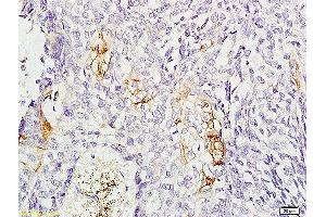 Formalin-fixed and paraffin-embedded: human esophageal cancer labeled with Rabbit Anti-CD11C Polyclonal Antibody, Unconjugated  1:200 followed by conjugation to the secondary antibody and DAB staining