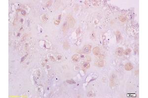 Formalin-fixed and paraffin embedded human placenta tissue labeled with Anti-Phospho-Estrogen Receptor alpha (Ser118) Polyclonal Antibody, Unconjugated (ABIN684568) at 1:200 followed by conjugation to the secondary antibody and DAB staining (Estrogen Receptor alpha anticorps  (pSer118))