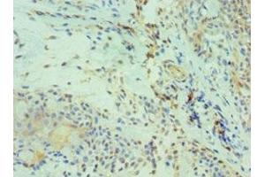 Immunohistochemistry of paraffin-embedded human breast cancer using ABIN7146211 at dilution of 1:100 (Cadherin 13 anticorps  (AA 120-370))