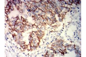 Immunohistochemical analysis of paraffin-embedded ovarian cancer tissues using NCAM1 mouse mAb with DAB staining. (CD56 anticorps)