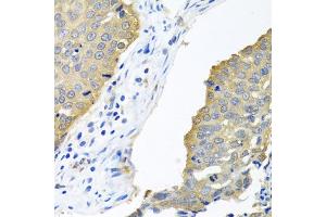 Immunohistochemistry of paraffin-embedded human lung cancer using EIF4E antibody (ABIN5971189) at dilution of 1/100 (40x lens). (EIF4E anticorps)