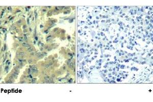 Immunohistochemical analysis of paraffin-embedded human lung carcinoma tissue using PLCG2 polyclonal antibody . (Phospholipase C gamma 2 anticorps  (Tyr1217))
