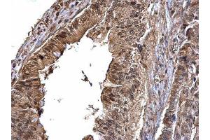 IHC-P Image CDK6 antibody [N1C3] detects CDK6 protein at cytoplasm and nucleus on human colon carcinoma by immunohistochemical analysis.