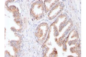 Formalin-fixed, paraffin-embedded human Prostate Carcinoma stained with FOLH1 Rabbit Recombinant Monoclonal Antibody (FOLH1/3149R). (Recombinant PSMA anticorps  (AA 232-433))