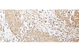 Immunohistochemistry of paraffin-embedded Human esophagus cancer tissue using ZKSCAN3 Polyclonal Antibody at dilution of 1:50(x200) (ZKSCAN3 anticorps)