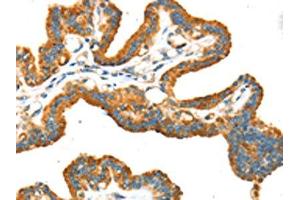 The image on the left is immunohistochemistry of paraffin-embedded Human thyroid cancer tissue using ABIN7192934(TRPV5 Antibody) at dilution 1/25, on the right is treated with synthetic peptide.