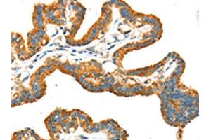 The image on the left is immunohistochemistry of paraffin-embedded Human thyroid cancer tissue using ABIN7192934(TRPV5 Antibody) at dilution 1/25, on the right is treated with synthetic peptide. (TRPV5 anticorps)