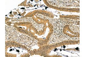 ABIN7094431 and ABIN7098479 at 1/100 staining Human colorectal cancer by IHC-P.