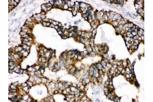 Anti- TRAP1 Picoband antibody, IHC(P) IHC(P): Human Intestinal Cancer Tissue (TRAP1 anticorps  (AA 571-704))