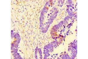 Immunohistochemistry of paraffin-embedded human ovarian cancer using ABIN7171154 at dilution of 1:100