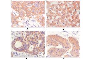 Immunohistochemical analysis of paraffin-embedded human lung squamous cell carcinoma (A),normal hepatocyte (B), colon adenocacinoma, normal stomach tissue (D), showing cytoplasmic and membrane localization using CK antibody with DAB staining. (pan Keratin anticorps)