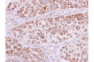 IHC-P Image PSKH1 antibody detects PSKH1 protein at cytooplasm and membrane on human liver carcinoma by immunohistochemical analysis. (PSKH1 anticorps)
