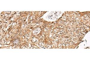 Immunohistochemistry of paraffin-embedded Human lung cancer tissue using C14orf169 Polyclonal Antibody at dilution of 1:45(x200) (C14orf169 + NO66 anticorps)