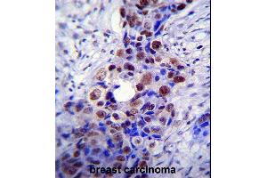 HDAC2 Antibody (C-term) (ABIN6242378 and ABIN6577318) immunohistochemistry analysis in formalin fixed and paraffin embedded human breast carcinoma followed by peroxidase conjugation of the secondary antibody and DAB staining. (HDAC2 anticorps  (C-Term))