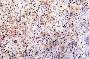 Immunohistochemistry (IHC) analyzes of p-P53 antibody in paraffin-embedded human breast carcinoma tissue. (p53 anticorps  (pSer20))