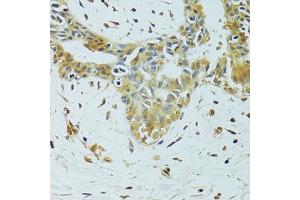 Immunohistochemistry of paraffin-embedded human breast cancer using METTL13 antibody. (METTL13 anticorps)
