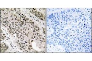 Immunohistochemistry analysis of paraffin-embedded human lung carcinoma tissue, using TNNI3K Antibody. (TNNI3K anticorps  (AA 301-350))