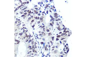 Immunohistochemistry of paraffin-embedded human colon carcinoma using Ku70 Rabbit mAb (ABIN7271407) at dilution of 1:100 (40x lens). (XRCC6 anticorps)