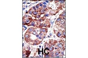 Formalin-fixed and paraffin-embedded human cancer tissue reacted with the primary antibody, which was peroxidase-conjugated to the secondary antibody, followed by DAB staining.