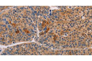 Immunohistochemistry of paraffin-embedded Human liver cancer using ALDH3A1 Polyclonal Antibody at dilution of 1:55