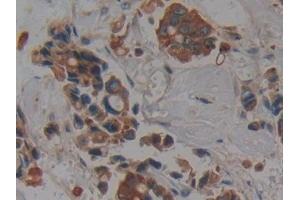 Detection of CK4 in Human Breast cancer Tissue using Polyclonal Antibody to Cytokeratin 4 (CK4) (KRT4 anticorps  (AA 152-457))