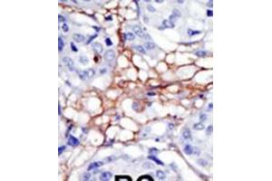 Formalin-fixed and paraffin-embedded human cancer tissue reacted with the primary antibody, which was peroxidase-conjugated to the secondary antibody, followed by DAB staining. (PIP4K2A anticorps  (N-Term))