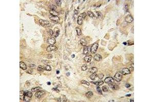IHC analysis of FFPE human lung carcinoma tissue stained with SOX-2 antibody (SOX2 anticorps  (AA 89-119))