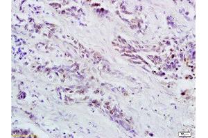 Formalin-fixed and paraffin embedded human colorectal cancer labeled with Anti OCT4B-190 Polyclonal Antibody, Unconjugated  at 1:200 followed by conjugation to the secondary antibody and DAB staining (Oct-4BOCT4B-190NT (AA 201-300) anticorps)