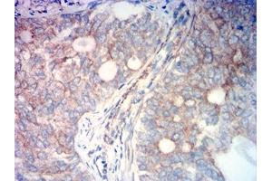 Immunohistochemical analysis of paraffin-embedded cervical cancer tissues using FAP mouse mAb with DAB staining.
