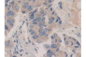 Detection of CHGB in Human Breast cancer Tissue using Polyclonal Antibody to Chromogranin B (CHGB) (CHGB anticorps  (AA 496-669))