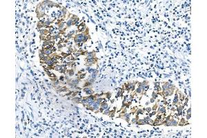IHC analysis of Cytokeratin 18 using anti-Cytokeratin 18 antibody (ABIN7600573). (Cytokeratin 18 anticorps  (AA 204-430))